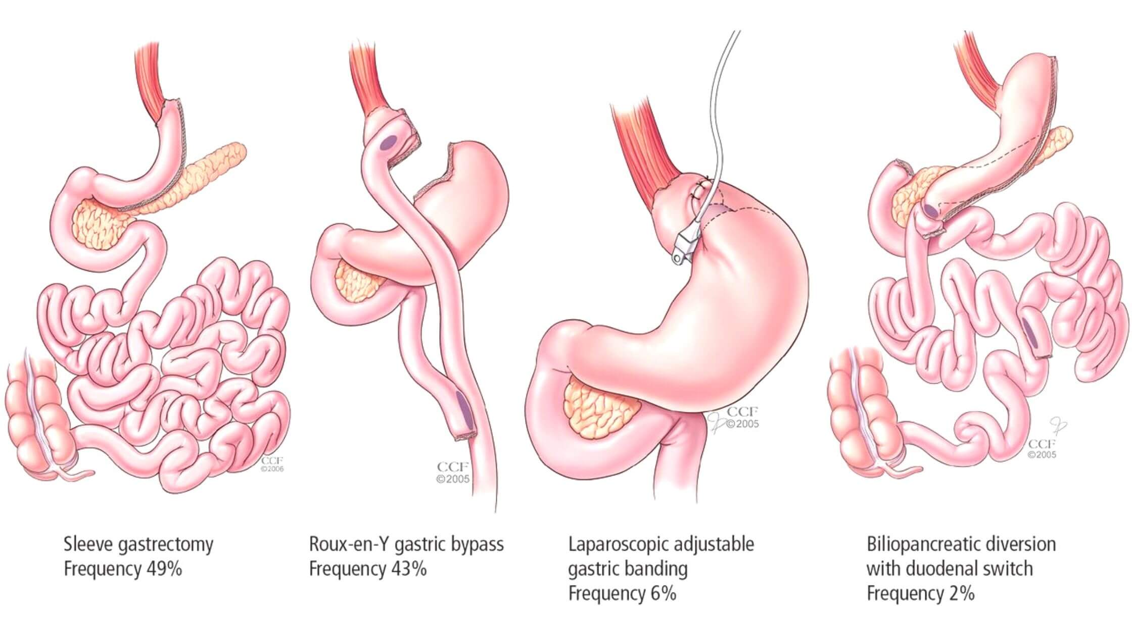 Laparoscopic Surgery For Diabetes