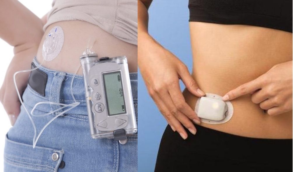 Differences Between Traditional Insulin Pump & Patch Pump