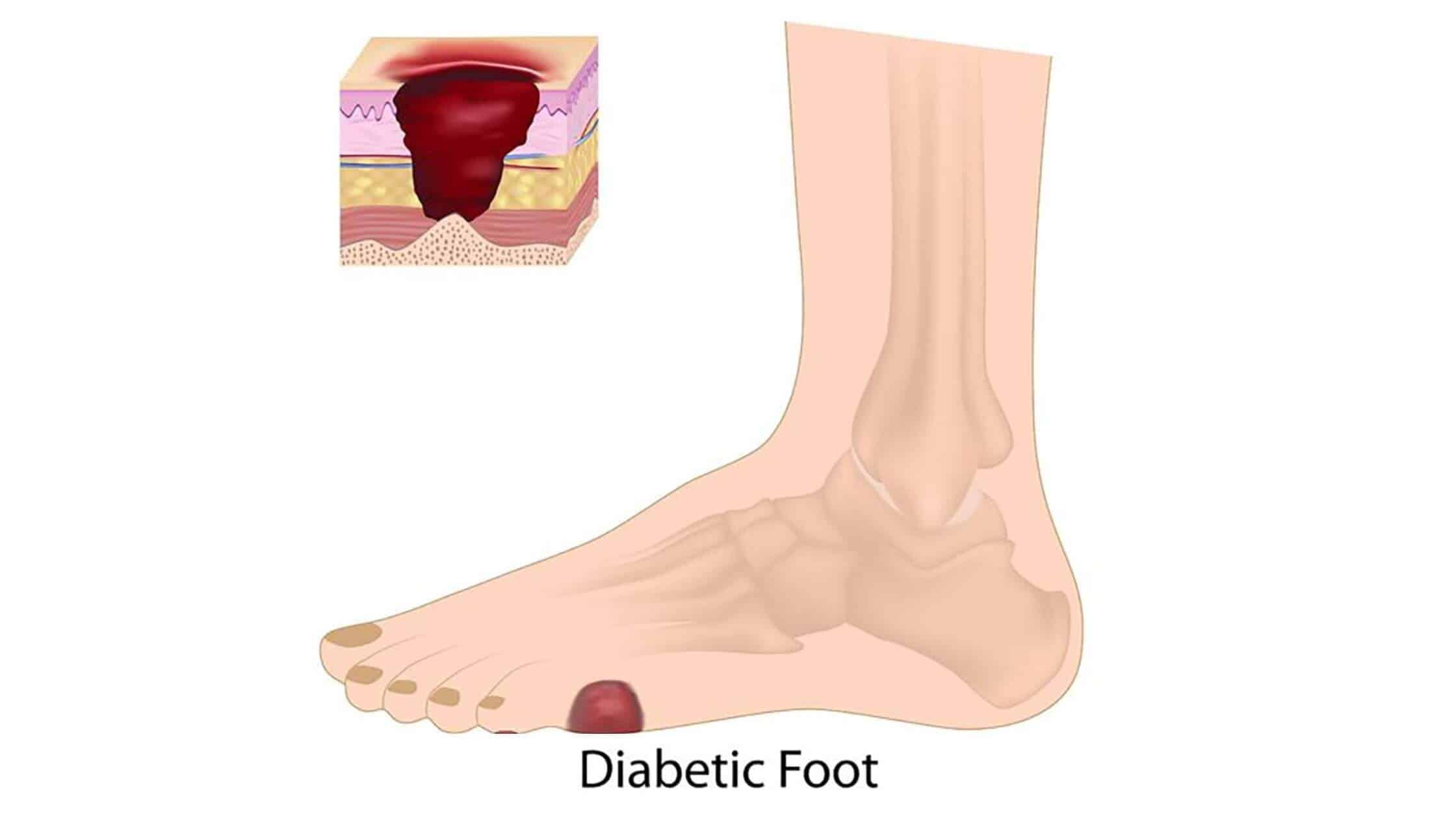 Diabetic Neuropathy Treatments